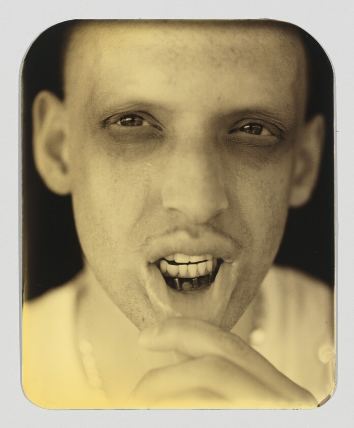 Close-up of a man pulling down his lower lip to show missing and darkened teeth.