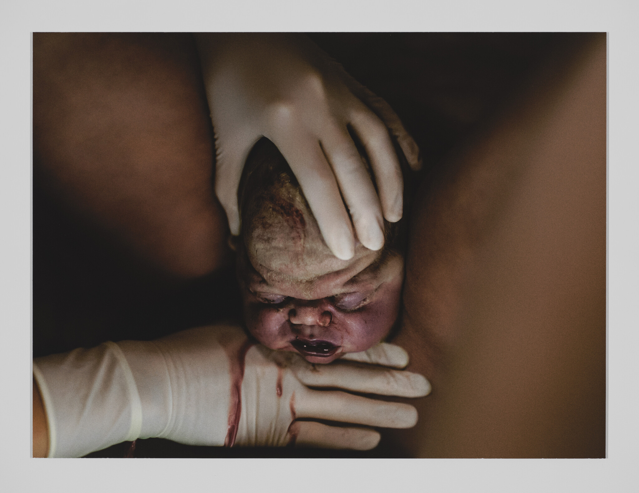 A newborn baby is being held by a person wearing surgical gloves, with the baby's head and face appearing to be covered in vernix, a white substance that protects the skin of the fetus. The baby's eyes are closed, and there is a visible presence of blood, indicating a recent birth. The image captures a powerful moment of the beginning of life with a focus on the infant's face and the caregiver's hands.