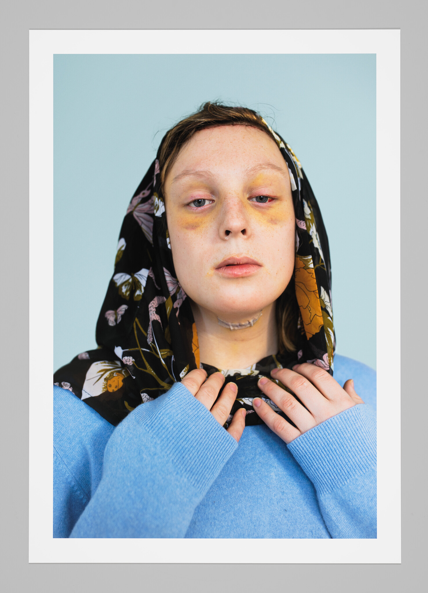 Young person with bruised eyes and neck stitches holds a floral headscarf around their throat.