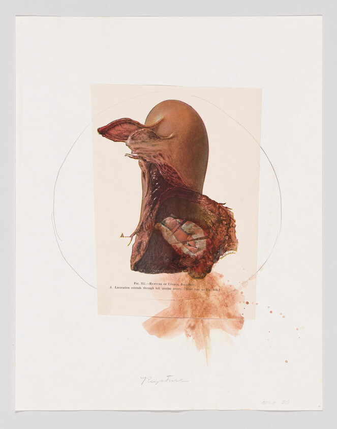 Anatomical illustration of a human throat and mouth, showing internal structures and a labeled laceration.